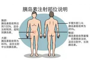 上图是成人胰岛素注射部位，除了腹部，上臂外侧、大腿前外侧、臀部均可注射。
